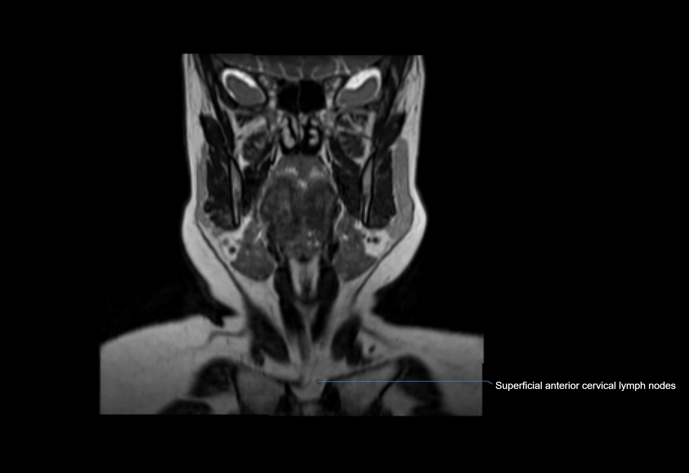 Neck coronal lymph node cross sectional MRI anatomy 3T MRI  image-img-00001-00049.webp